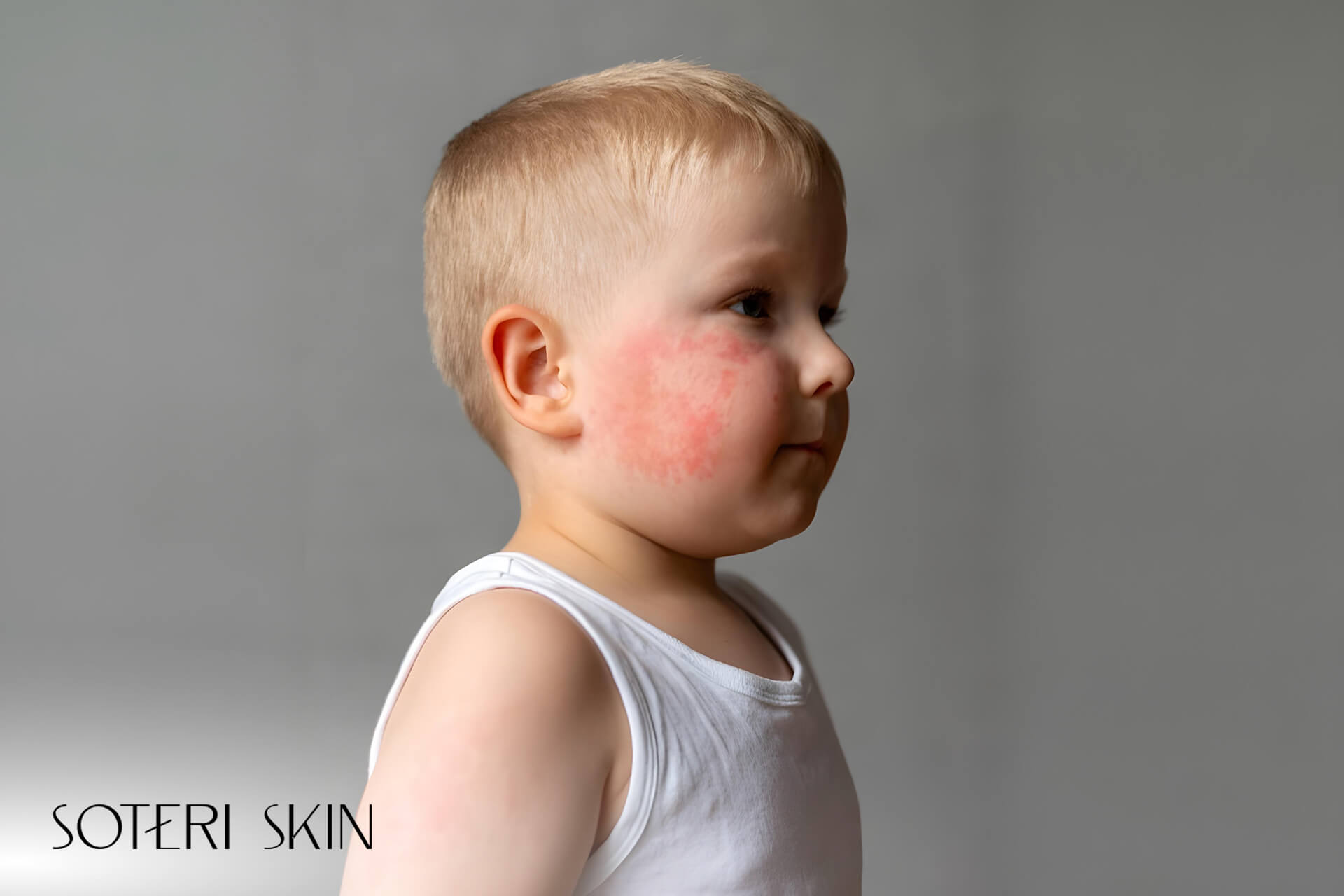 Baby Heat Rash: Causes, Prevention, and Treatments